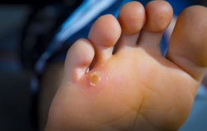 Corns Can Be Painful, and Relief Is Often Sought