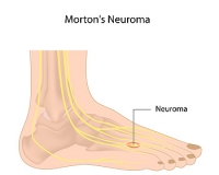 What Causes Morton’s Neuroma?